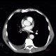 Small cell lung carcinoma, SCLC, metastasis in pancreas, after therapy: CT - Computed tomography
